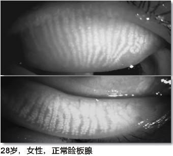 日本拓普康topcon非接触式睑板腺观察系统bg-4m